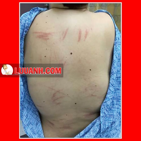 Ban ngứa ở bệnh nhân u lympho Hodgkin