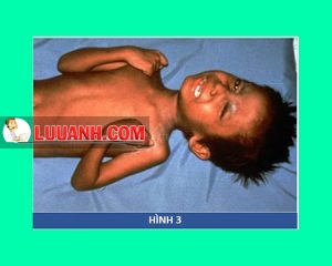 bệnh uốn ván