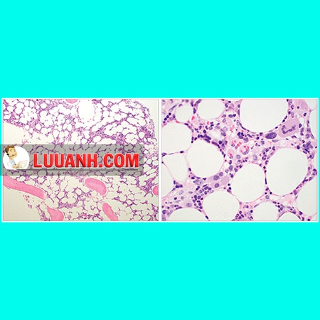 [Case Hm8803 hiện đang mở] Bệnh nhân nữ sốt và hạch to