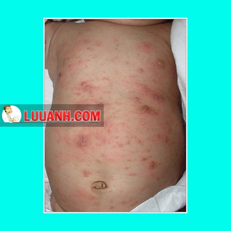 Trẻ quấy khóc kèm mụn sẩn toàn thân 3 trẻ