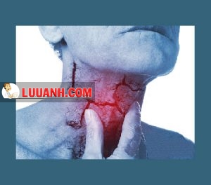7 DẤU HIỆU PHÁT HIỆN SỚM UNG THƯ HẠ HỌNG