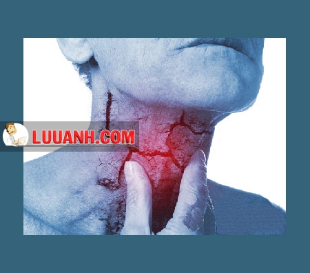 7 DẤU HIỆU PHÁT HIỆN SỚM UNG THƯ HẠ HỌNG