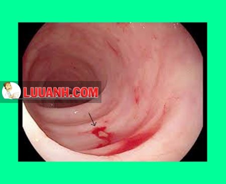chảy máu đường tiêu hoá