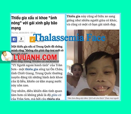 DIỄN NÔM THÔNG NÃO VỀ THALASSEMIA (tan máu bẩm sinh) 1 THALASSEMIA