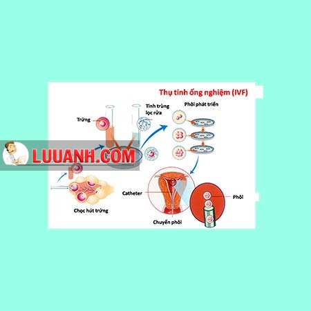 chuyển phôi trữ