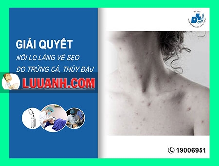 Cách chữa sẹo lõm do mụn trứng cá, bệnh thủy đậu 1 sẹo