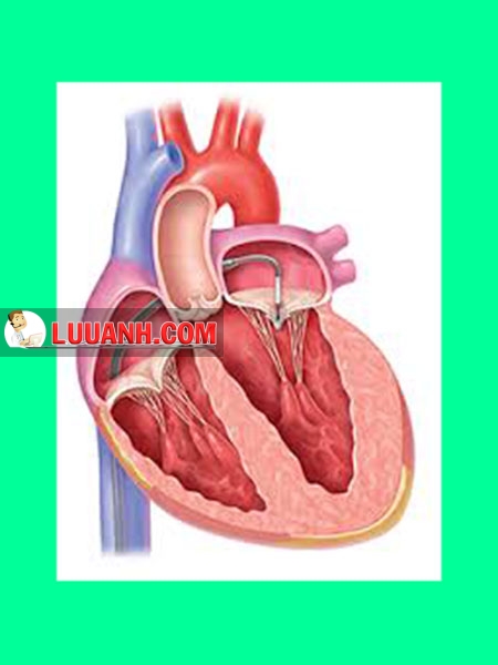 transcatheter clip