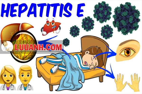 Bệnh nhân bị Viêm gan E