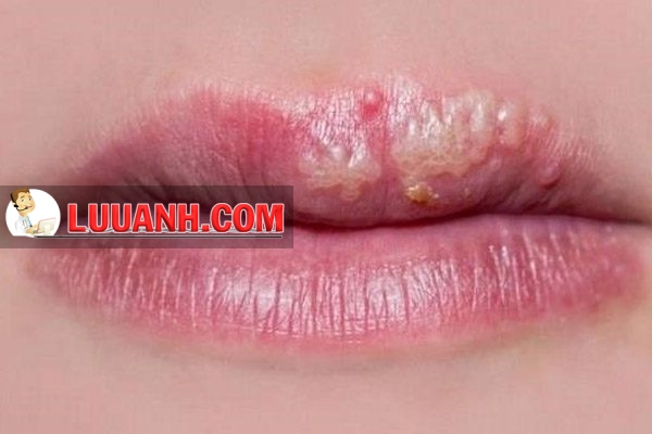 Bệnh nhân bị bệnh chàm môi