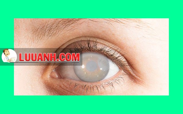 bệnh đục thủy tinh thể