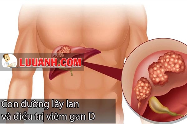 bệnh viêm gan D