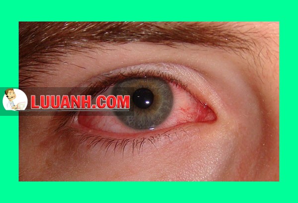 Một số lưu ý khi sử dụng các thuốc điều trị viêm kết mạc dị ứng 6 viêm kết mạc dị ứng