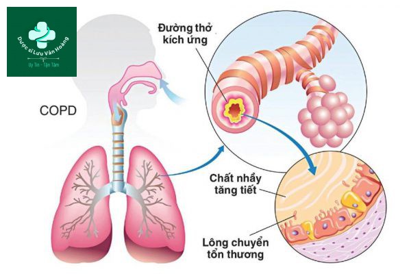 Bệnh phổi tắc nghẹn mạn tính