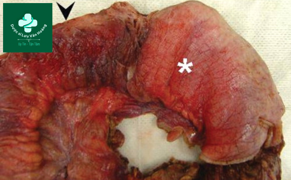 Tắc ruột non - Small Bowel Obstruction: What to Look For 33 Tac ruot non 11