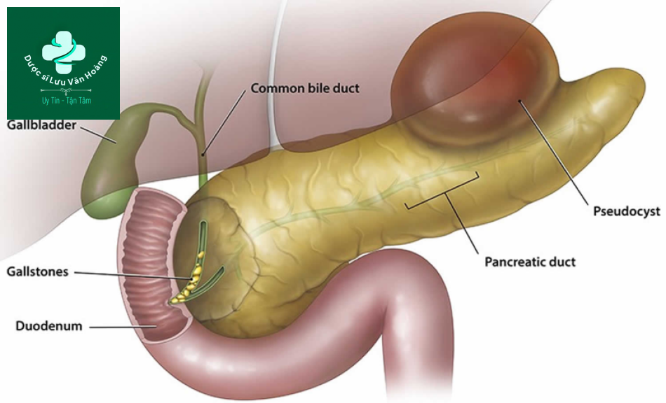 Nang giả tụy - Pancreatic pseudocysts 12 nang gia tuy