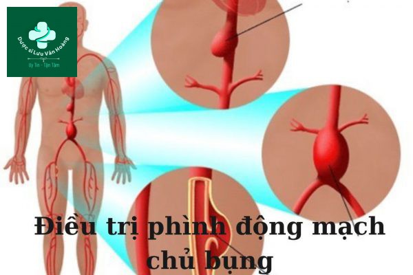 Điều trị phình động mạch chủ bụng