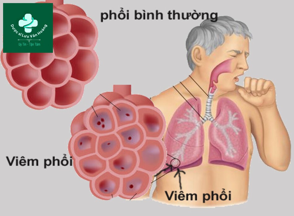 Hướng dẫn chẩn đoán và điều trị viêm phổi 41 Hướng dẫn chẩn đoán và điều trị viêm phổi