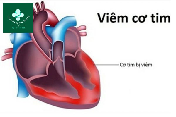 Viêm cơ tim