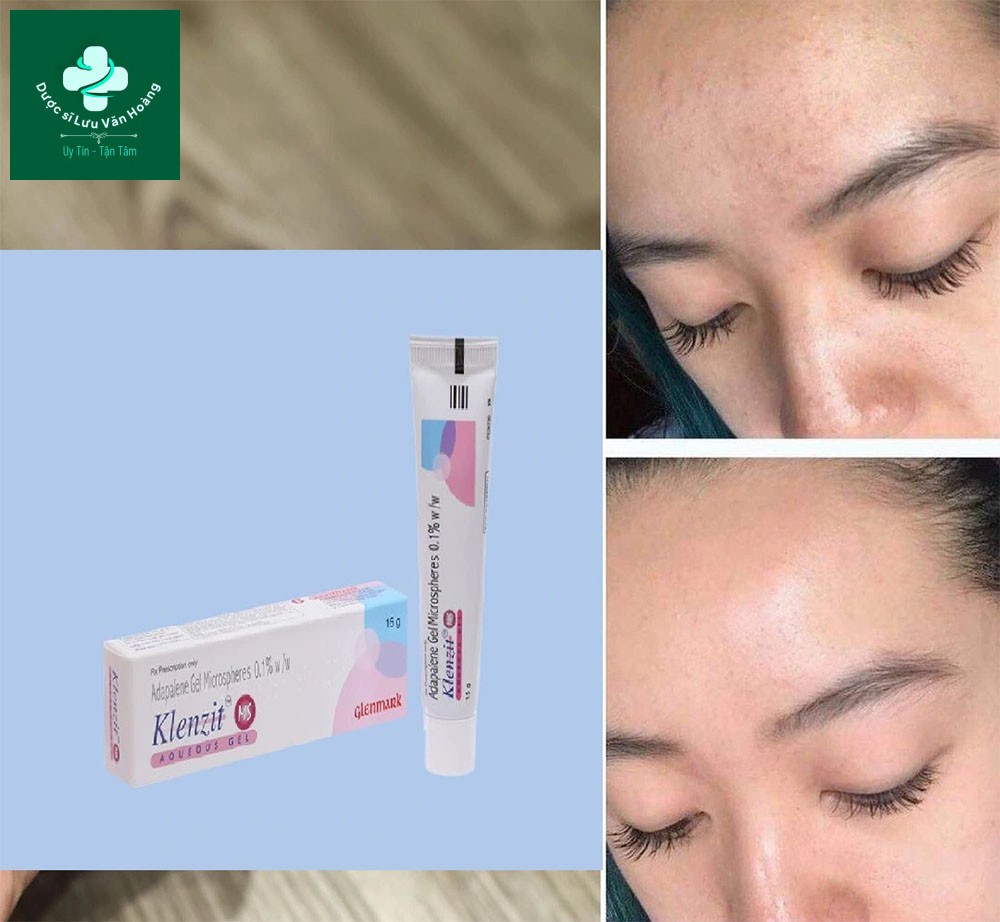 Klenzit MS giảm thâm mụn trứng cá