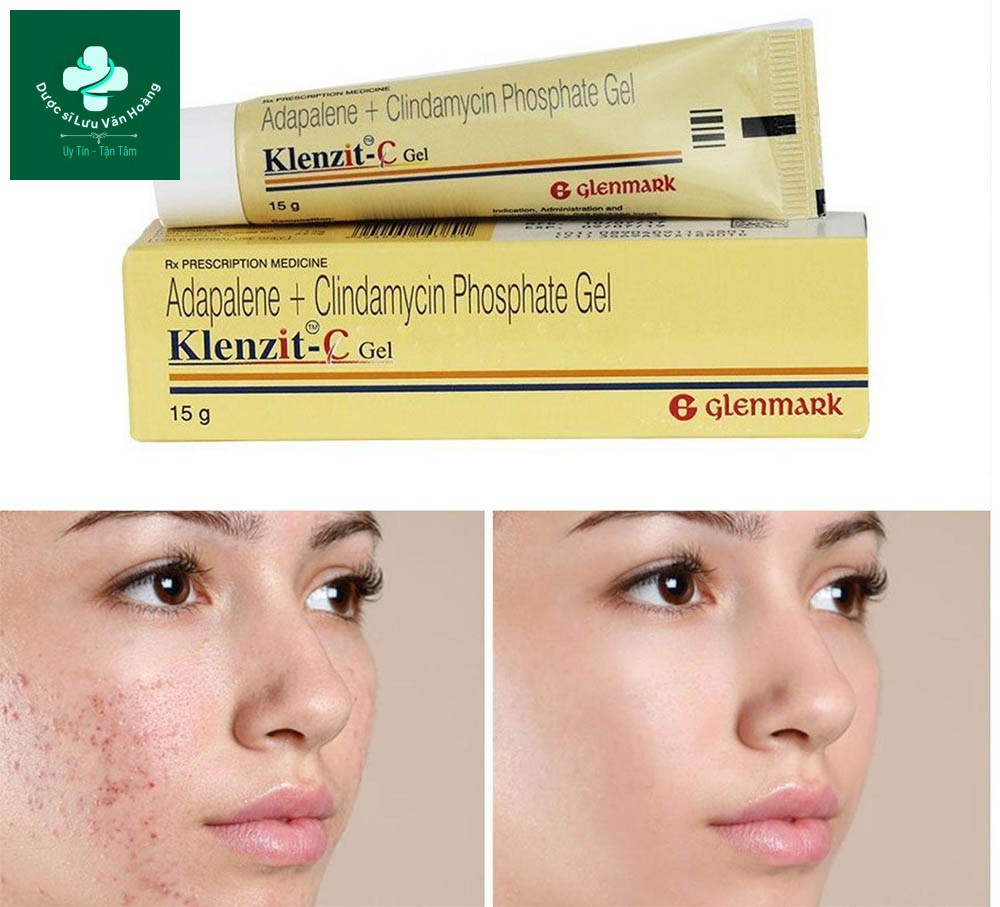 Giảm nhanh mụn trứng cá với thuốc Klenzit C