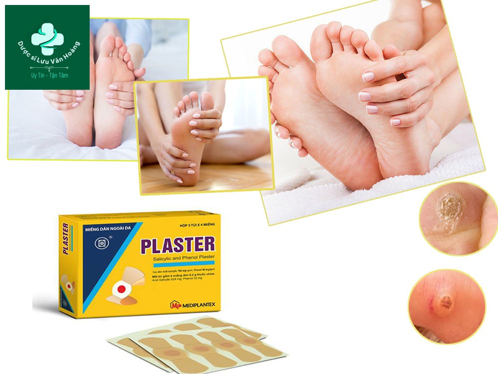 Điều trị mụn cóc bằng miếng dán Plasters khá tiện lợi và an toàn