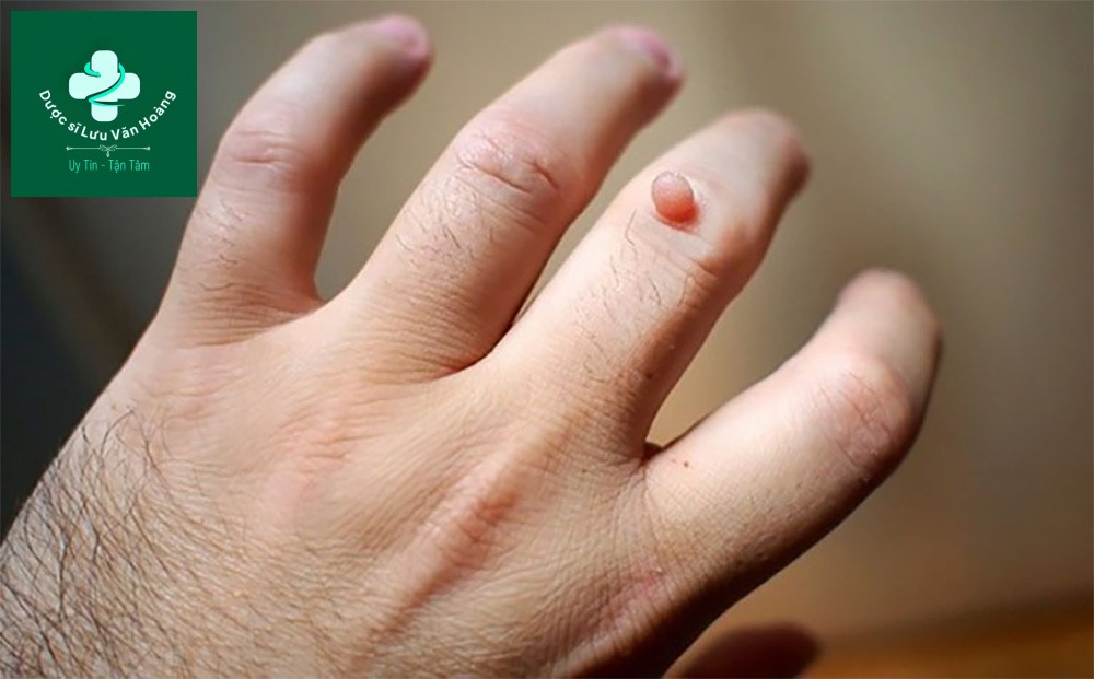Mụn cóc là các nốt mụn sần sùi nổi rõ trên bề mặt da do virus HPV gây ra