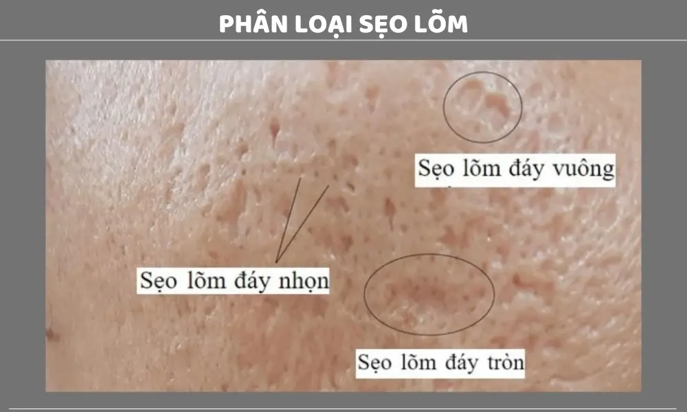 Phân loại các dạng sẹo rỗ, sẹo lõm thường gặp hiện nay