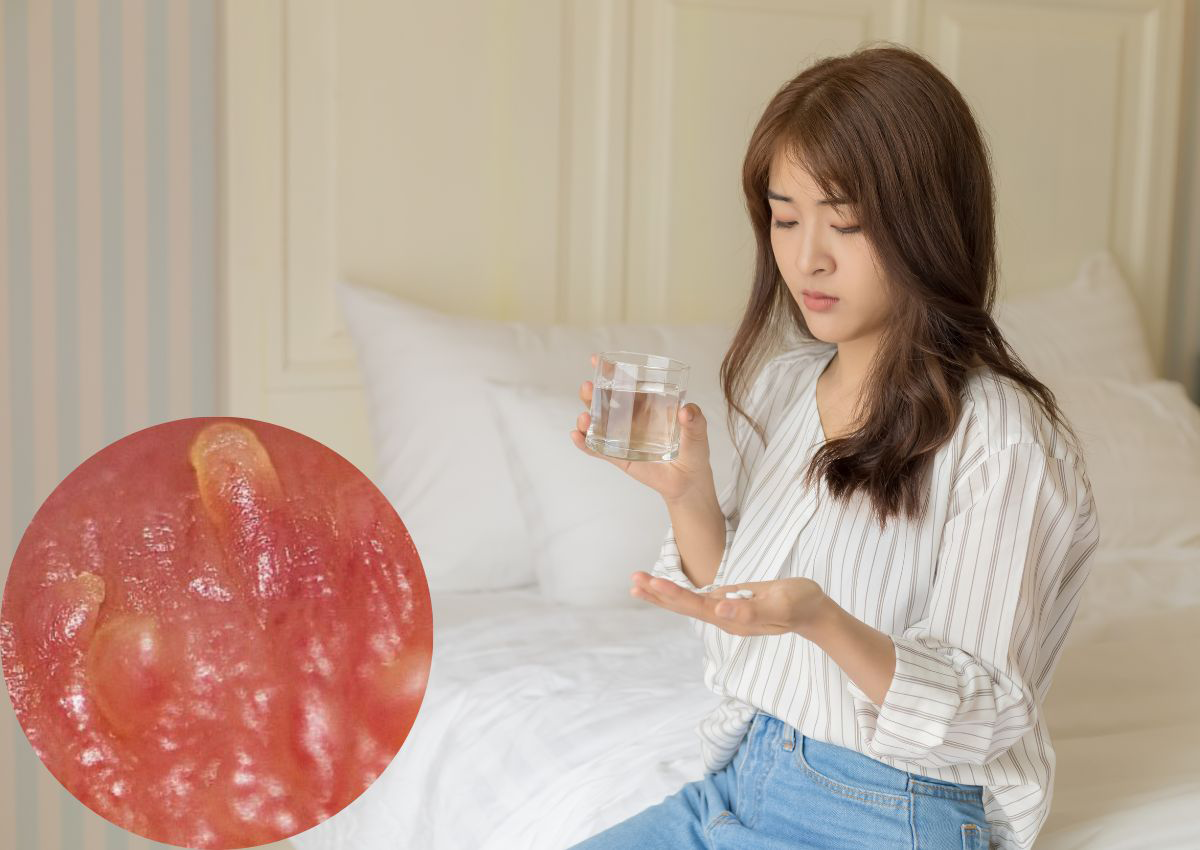 Thuốc trị Sùi mào gà đường uống