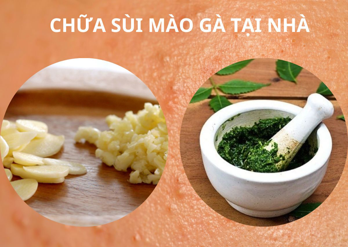 Kinh nghiệm chữa Sùi mào gà theo dân gian 