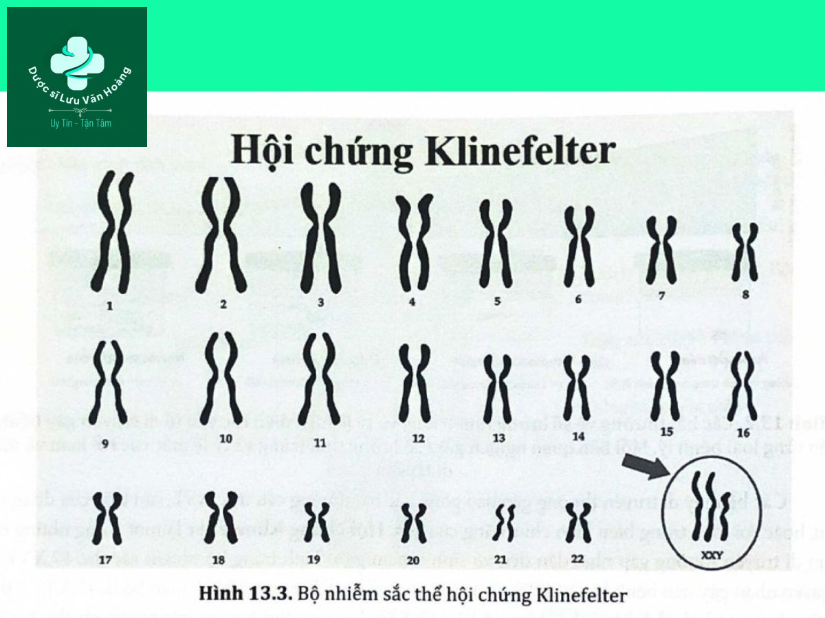 Rối loạn chức năng tình dục nam là gì? Nguyên nhân và các yếu tố nguy cơ 15 Hình 13.3. Bộ nhiễm sắc thể hội chứng Klinefelter