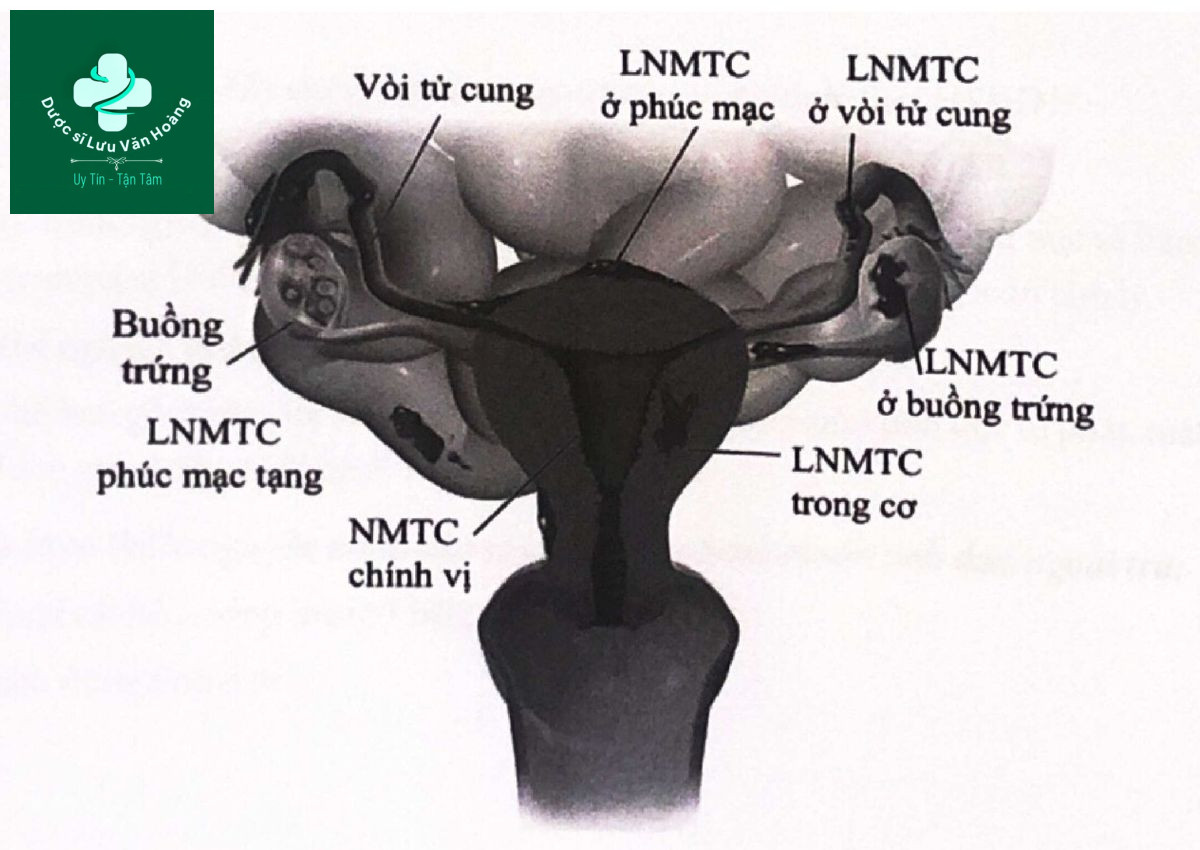 ​​Hình 8.1. Vị trí lạc nội mạc tử cung thường gặp