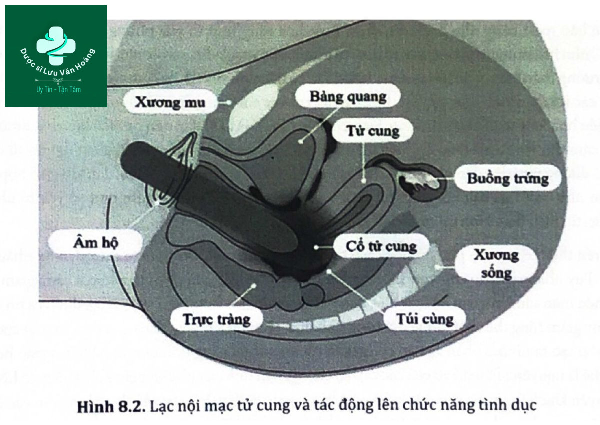 ​Hình 8.2. Lạc nội mạc tử cung và tác động lên chức năng tình dục