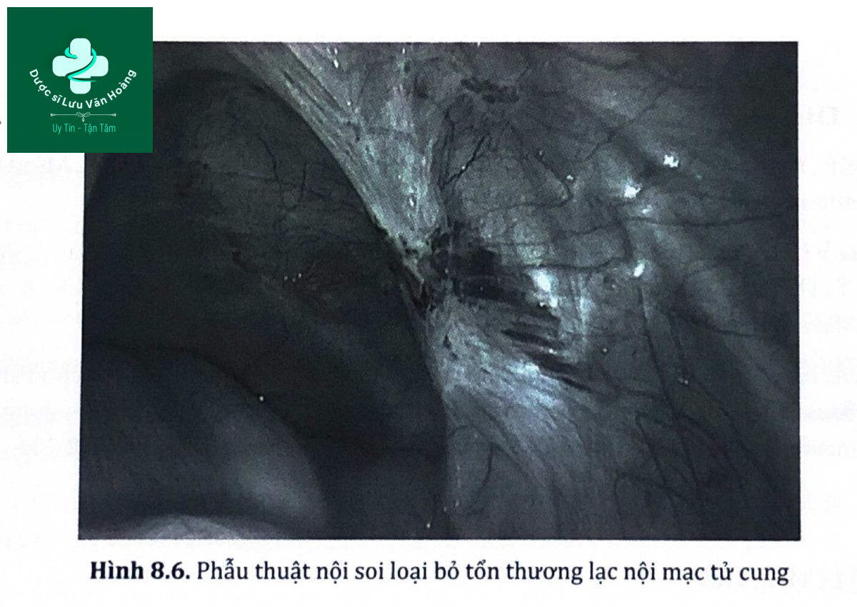 ​Hình 8.6. Phẫu thuật nội soi loại bỏ tổn thương lạc nội mạc tử cung