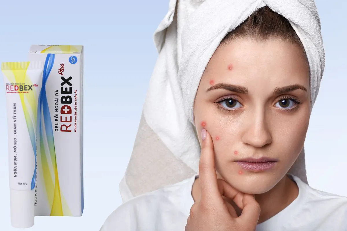 Redbex Plus 15g 18 Thuốc Redbex Plus 15g giảm mụn trứng cá