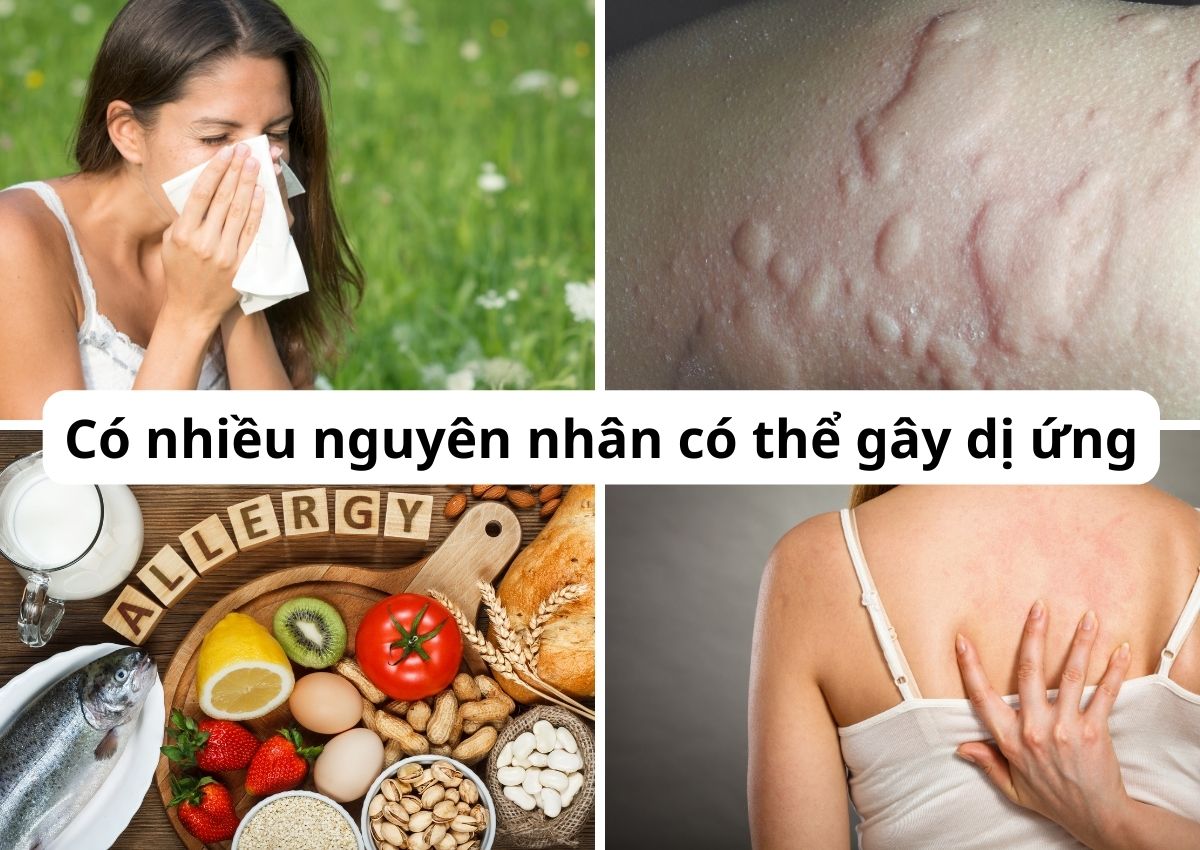 Thuốc dị ứng