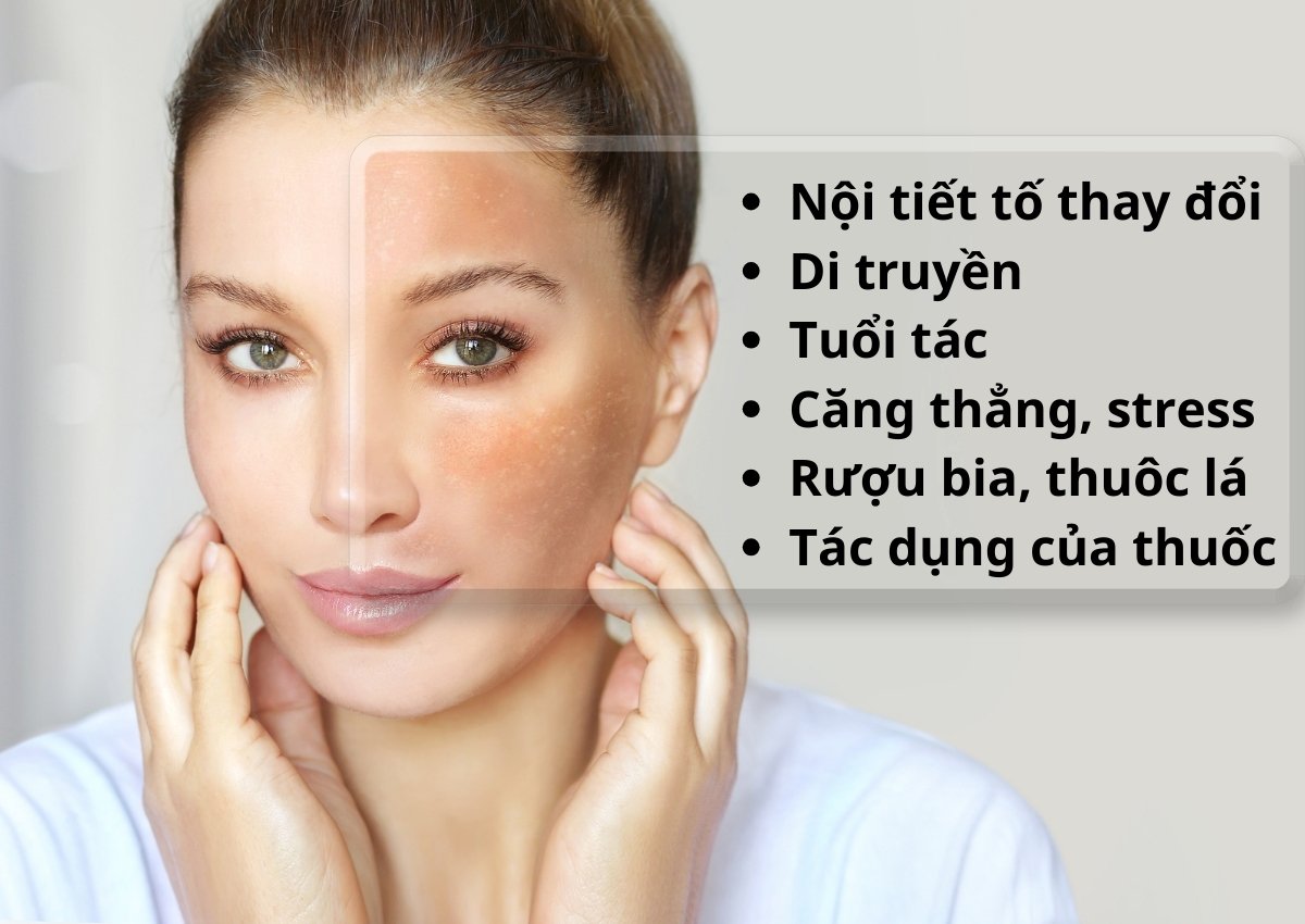 Nên lựa chọn thuốc trị nám da nào an toàn hiệu quả cao? 23 Thuốc trị nám