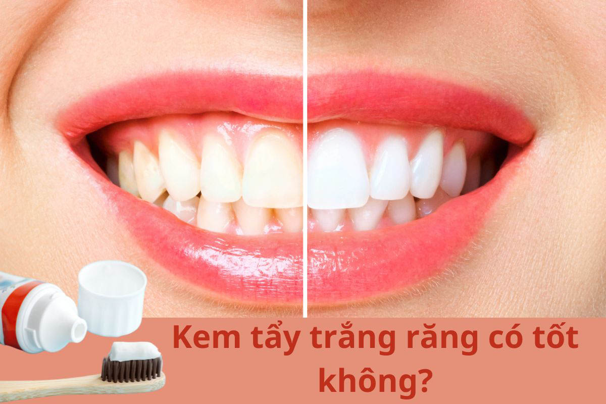 Kem tẩy trắng răng có tốt không?