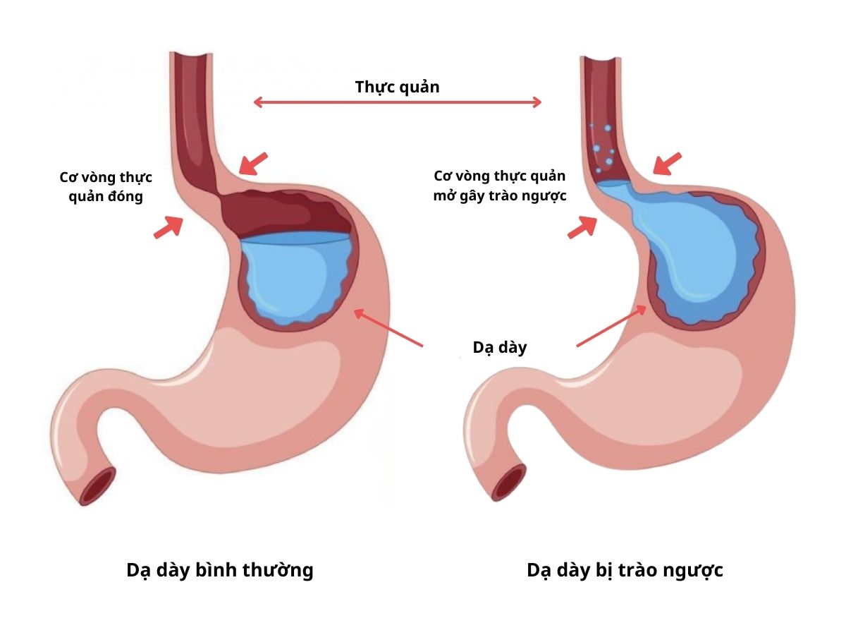5+ thuốc đặc trị trào ngược dạ dày tốt nhất 20 Nguyên nhân gây trào ngược dạ dày
