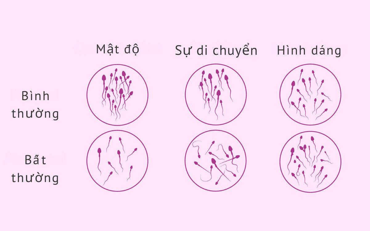 Đặc điểm tinh trùng bình thường và bất thường