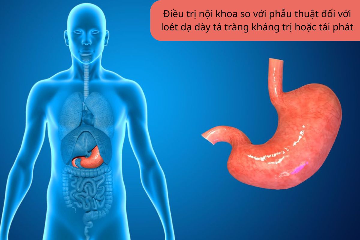 Điều trị nội khoa so với phẫu thuật đối với loét dạ dày tá tràng kháng trị hoặc tái phát 1 Điều trị nội khoa so với phẫu thuật đối với loét dạ dày tá tràng kháng trị hoặc tái phát