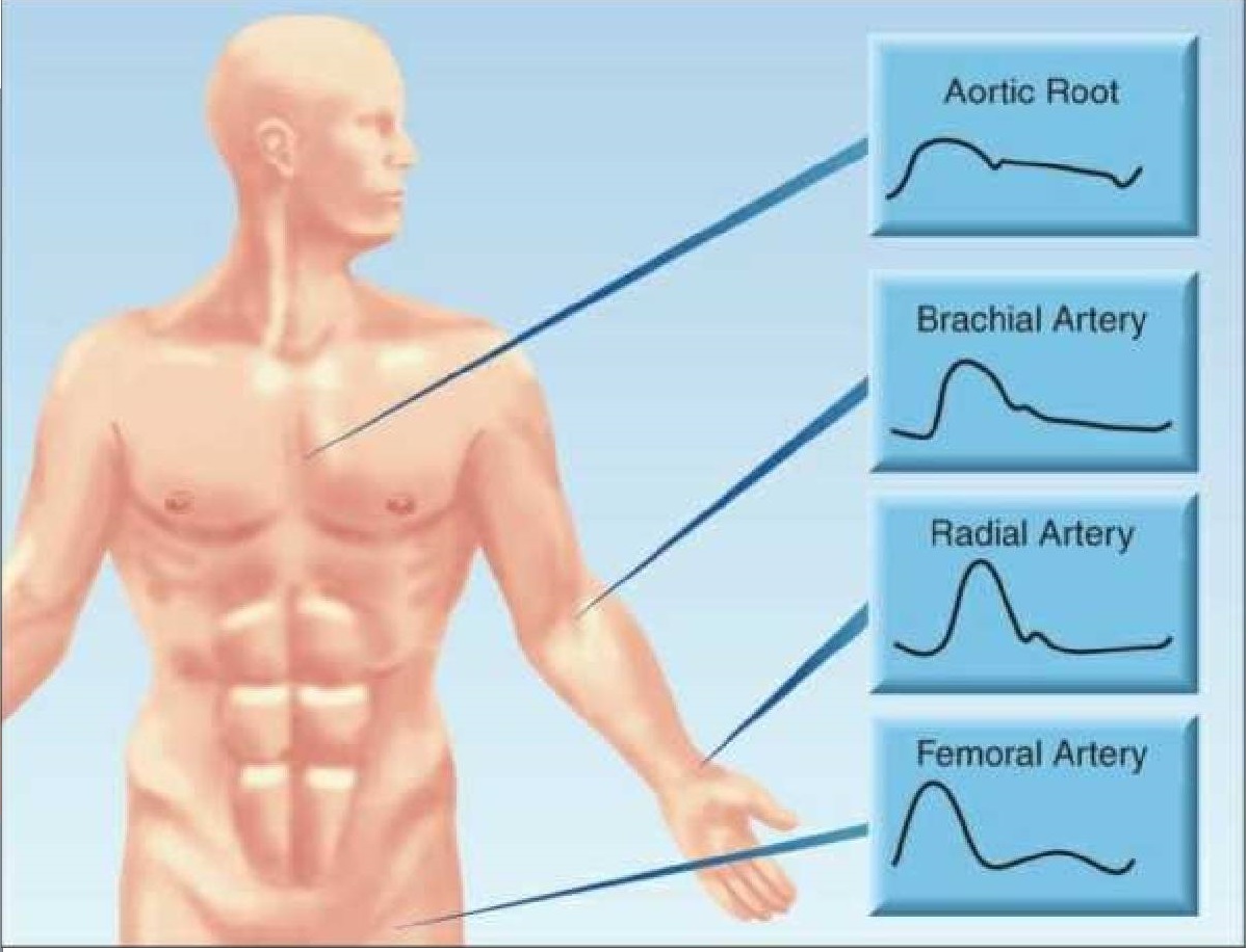 Chapter 14. TIẾP CẬN LÂM SÀNG SHOCK - Ths. Bs HỒ HOÀNG KIM – EDICU – BV NGUYỄN TRI PHƯƠNG 4 HÌNH 14.1 Dạng sóng áp lực động mạch tại các điểm cụ thể trong hệ tuần hoàn động mạch