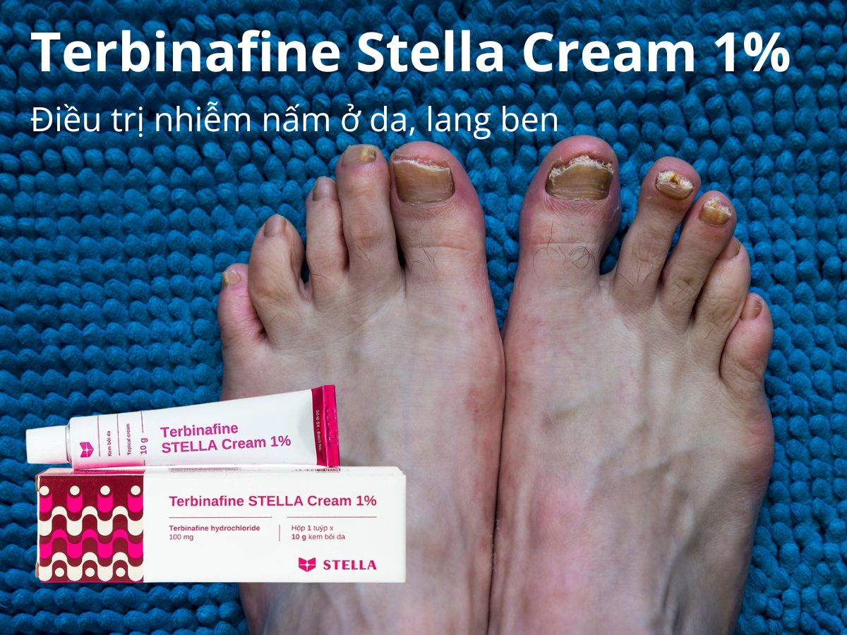 Terbinafine Stella Cream 1%