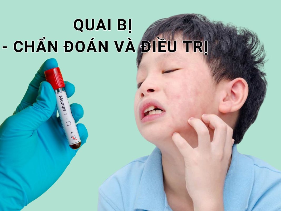 Quai bị - Tổng quan về biểu hiện Hm8803 hiện đang mở, điều trị và nguyên tắc phòng bệnh 1 Quai bị - Tổng quan về biểu hiện Hm8803 hiện đang mở, điều trị và nguyên tắc phòng bệnh