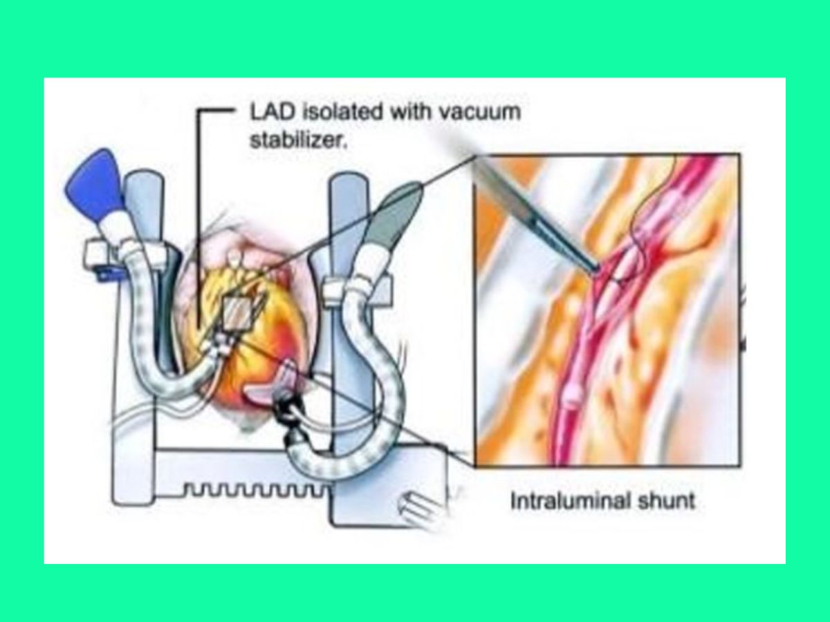 PHÁC ĐỒ 39: PHẪU THUẬT BẮC CẦU CHỦ-VÀNH 6 phau-thuat-bac-cau-chu-vanh-1