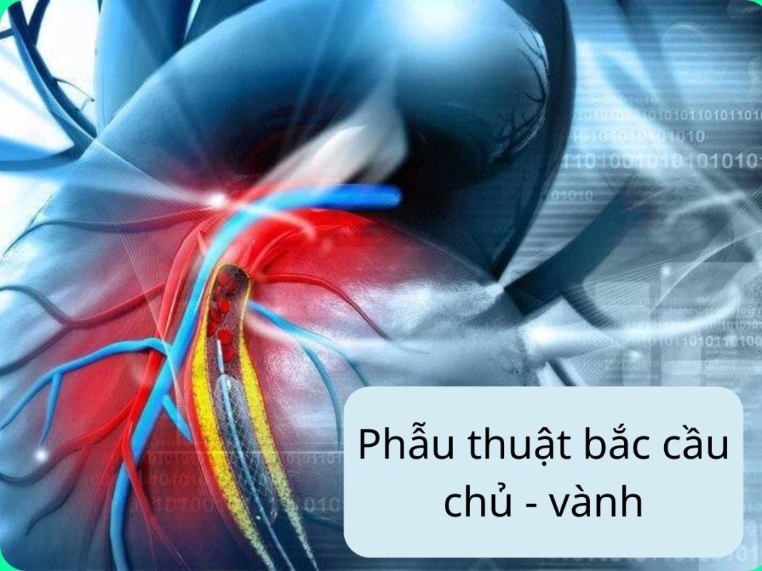 PHÁC ĐỒ 39: PHẪU THUẬT BẮC CẦU CHỦ-VÀNH 4 phau-thuat-bac-cau-chu-vanh-3