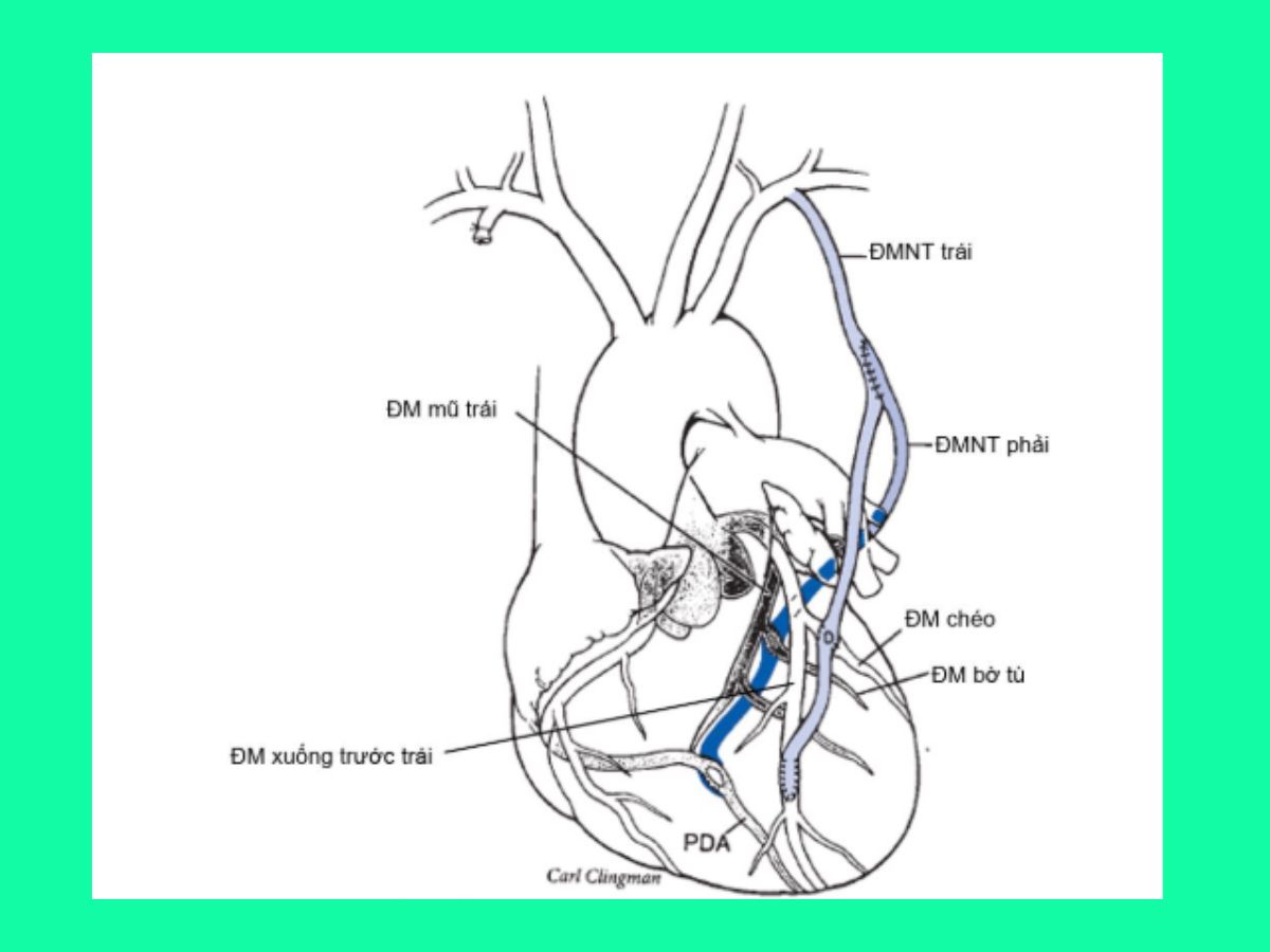 PHÁC ĐỒ 39: PHẪU THUẬT BẮC CẦU CHỦ-VÀNH 5 phau-thuat-bac-cau-chu-vanh