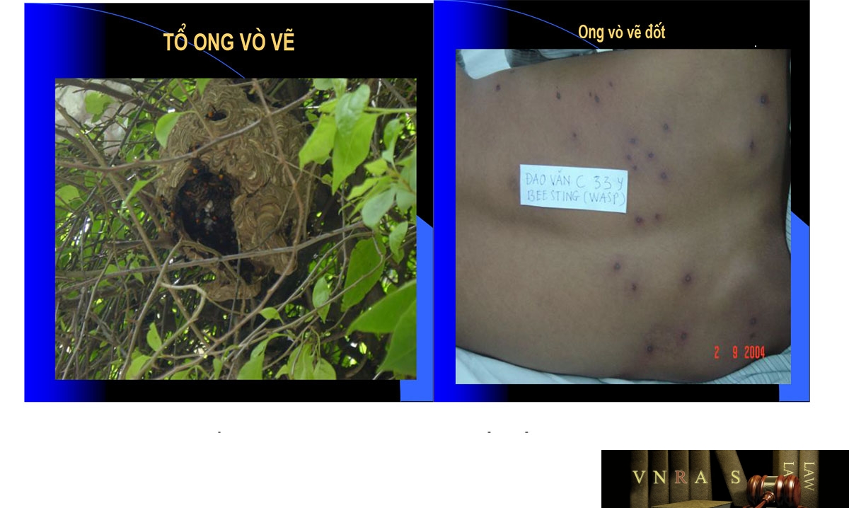 Hình 20.6: Tổ ong vò vẽ (bên trái) và vết đốt của ong vò vẽ (bên phải)(Trung tâm chống độc bệnh viện Bạch Mai)