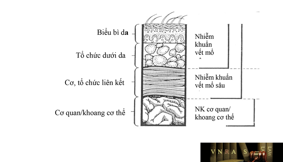 Hình 1: Sơ đồ phân loại nhiễm khuẩn vết mổ